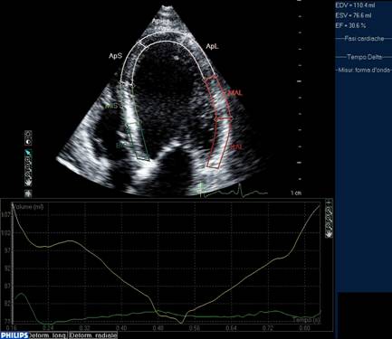 Frazione di eiezione cardiaca 35